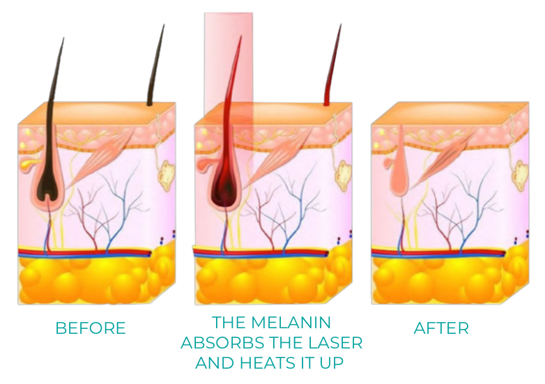 Disode Laser Hair Removal